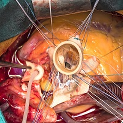 Nuovi dati a sette anni per le valvole aortiche realizzate in tessuto resilia mostrano risultati favorevoli in termini di durata, sicurezza ed efficacia